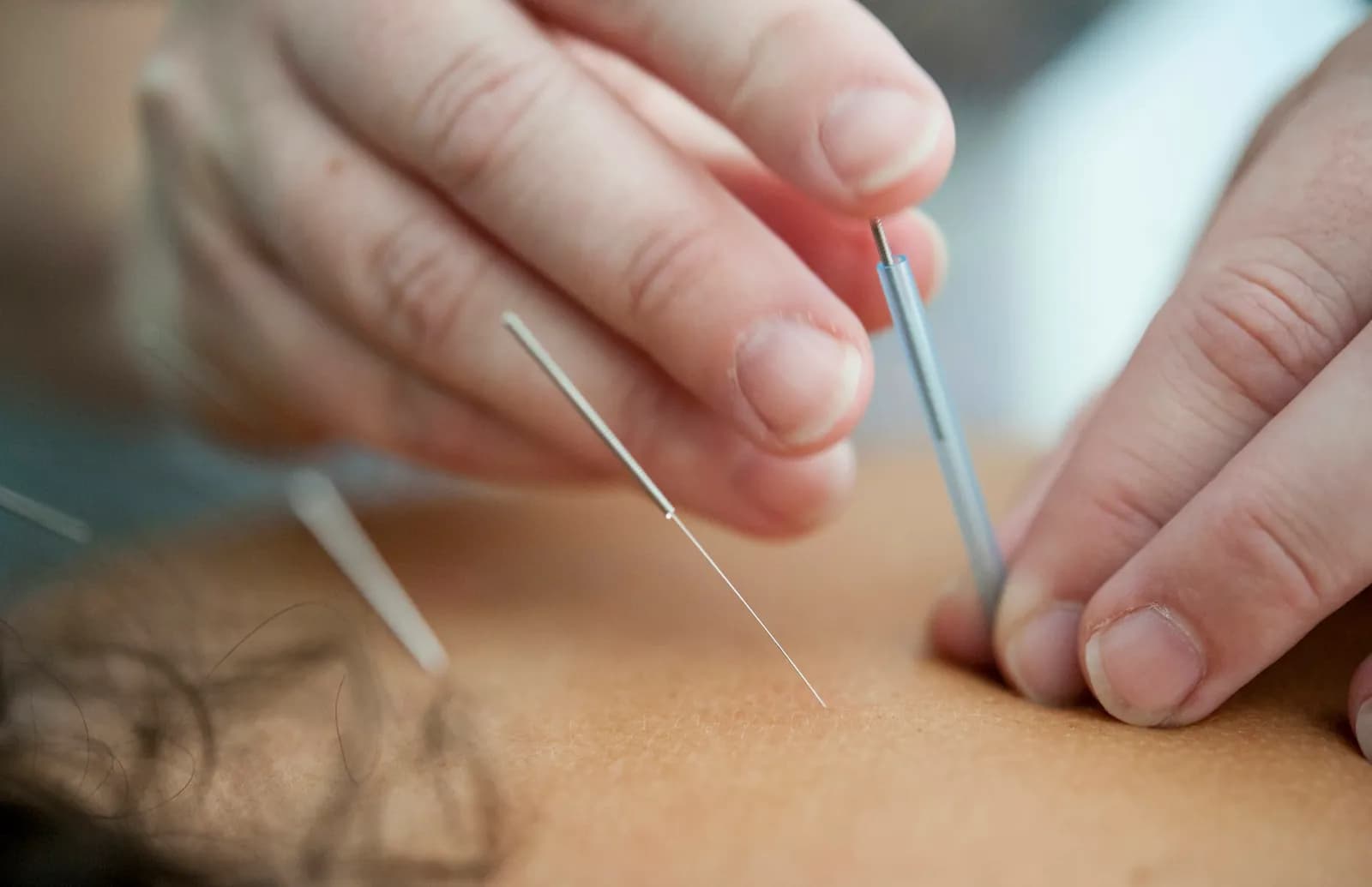 Fine needles being placed in the skin of a patient's back