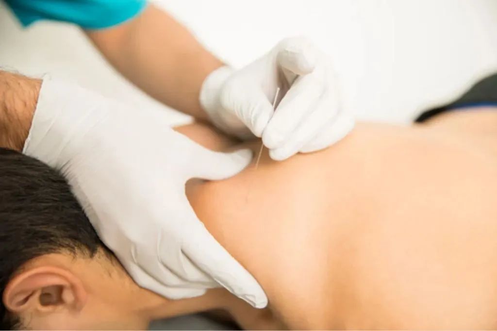 Gloved practitioner placing a dry needle near a patient's neck and shoulder